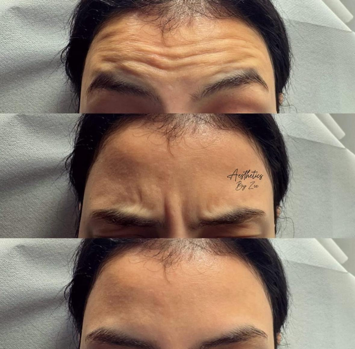 Anti-Wrinkle Treatments