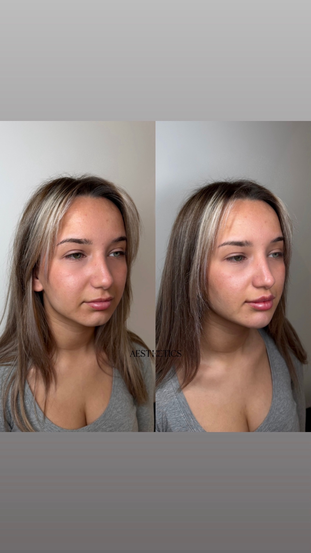 Dermal Fillers